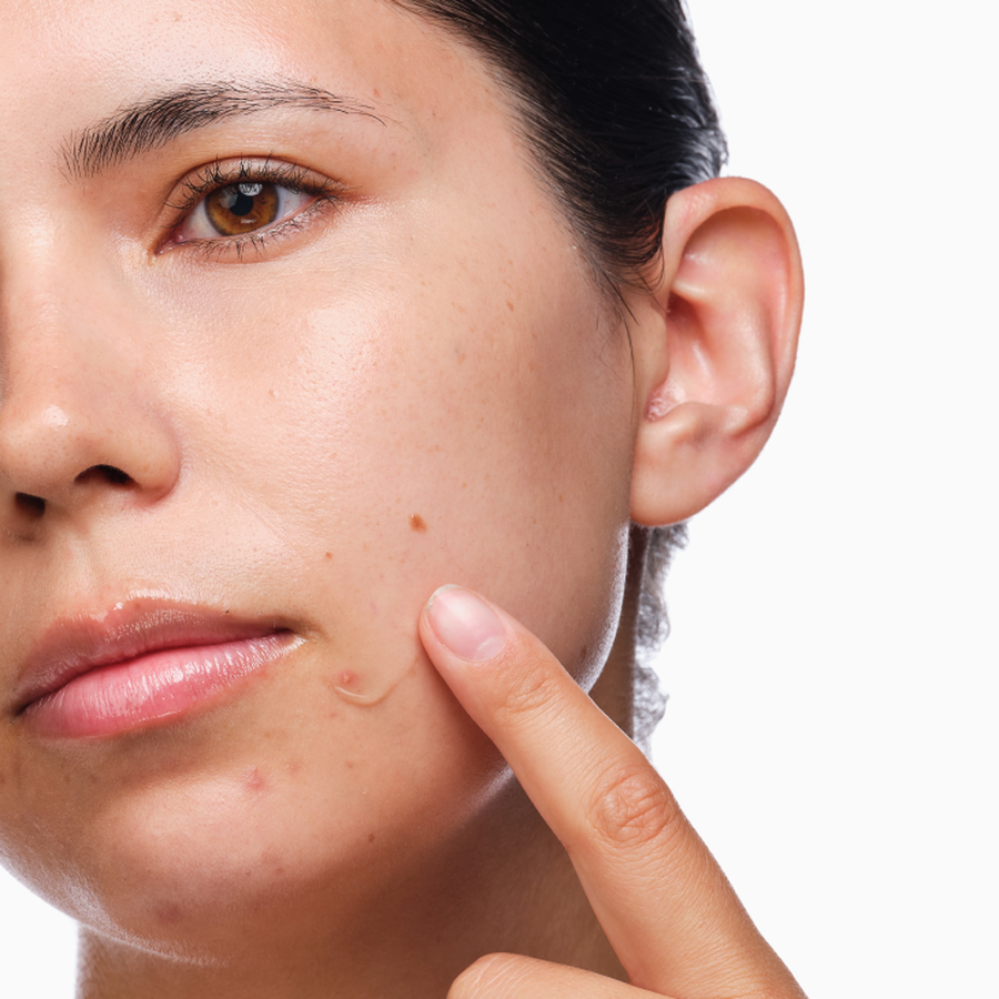 The Acne Set - Fresh Lineup